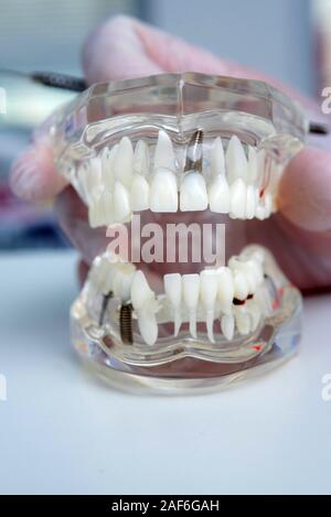the orthodontist holds a model of teeth with implants in his hand and ...