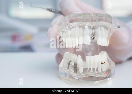 orthodontist holds a model of teeth with implants Stock Photo - Alamy