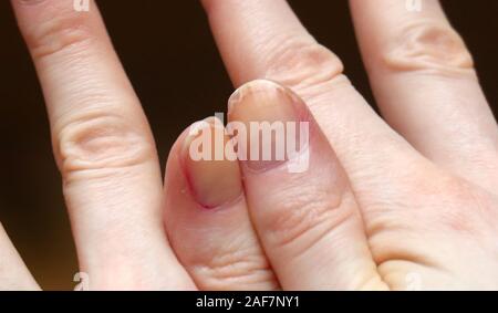 Cracked fingernails with brittle splitting and peeling nails Stock Photo