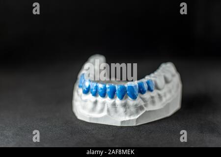 Close-up on plaster model of artificial jaw with teeth painted in blue and transparent cap on the black background Stock Photo
