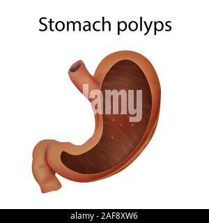 Stomach polyps, illustration Stock Photo