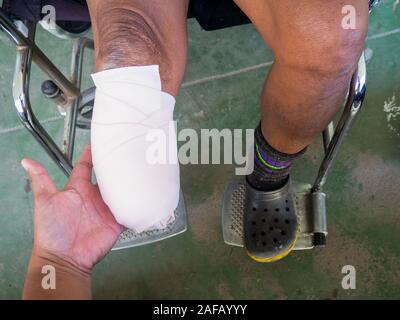 below knee amputation with elastic bandage Stock Photo