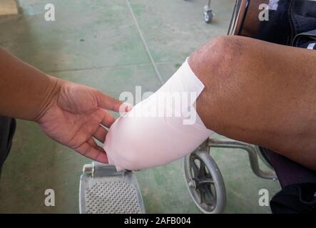 below knee amputation with elastic bandage Stock Photo