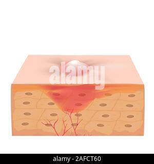 Inflamed acne on the skin. Inflamed pimple. The structure of the skin. Infographics. Vector illustration on isolated background. Stock Vector