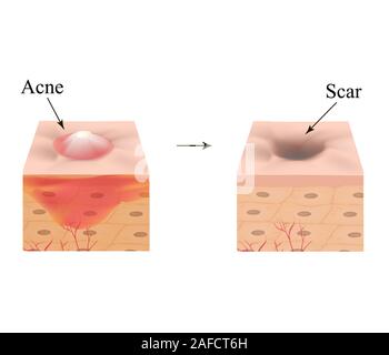 Inflamed acne on the skin. Inflamed pimple. The structure of the skin. Acne scar. Infographics. Vector illustration on isolated background. Stock Vector