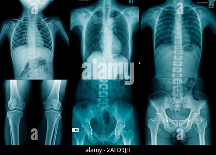 collection human x-ray image in blue tone Stock Photo