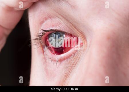 postoperative heavy inflamed eye closeup shot with selective focus Stock Photo