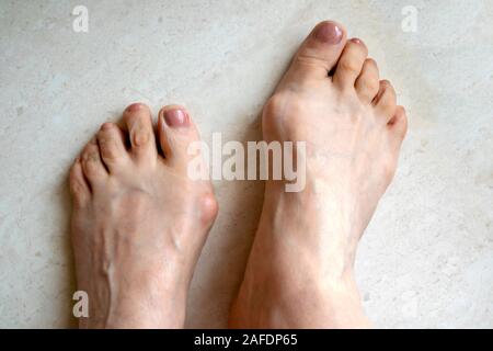 Hallux valgus, big abnormal feet bones.  Bunion on big toes of female feet isolated on light background Stock Photo