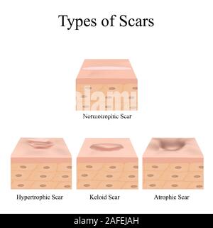 Types of scars. Acne scars. Keloid, hypertrophic, atrophic ...