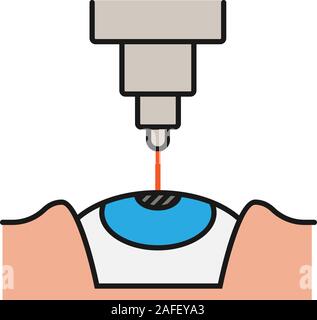 Medical illustration of LASIK and refractive surgery Stock Vector Image ...