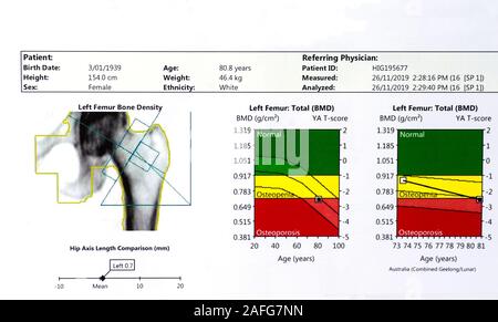 Left Femur Bone Density Scan and comparison chart of a female aged 80. Stock Photo