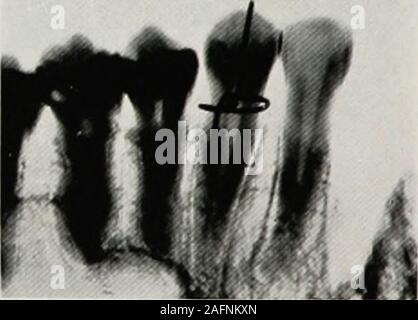 . Dental electro-therapeutics. Fig. 70 Fig 71 Dr. Ottolengui decided this matter as follows: Taking adried skull, he placed a wire around the tooth neck at exactlyone inch from the apex and then took the pictures at extremeopposite angles. The illustrations show the resulting radio-graphs. Computed by one of these, the tooth was shown to DENTAL RADIOGRAPHY 157 be ip inch in length and computed by the other, it wasshown to be xTnr m°b in length. In each instance, therefore,the variation from the truth was T^T inch. As the knowl-edge of the length of a living root is usually required only todete Stock Photo