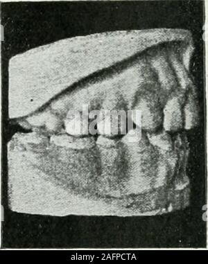 . Lehrbuch der orthodontie fur studierende und zahnartze mit enschluss der geschichte der orthodontie. Fig. 435. Fig. 436. nach der Behandlung darstellt, auch vollkommen gelungen.Fig. 437 veranschaulicht das hierzu gehörige Profil vor der Be- Stock Photo