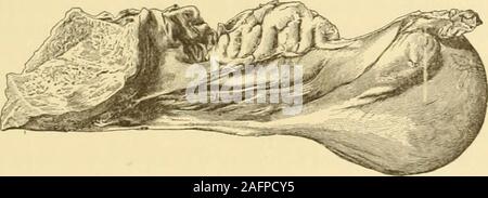 . Clinical gyncology, medical and surgical. Cyst of the parovarium, showing its relation to the ovary and tube.—A, oophoron;b, paroophoron; F, Fallopian tube. (Sutton.) a clinical importance far greater than was once assigned to them, as will beexplained subsequently. Parovarian cysts, whether small or large, presentcertain distinct anatomical characteristics with which every operator shouldfamiliarize himself. Since they grow between the folds of the broadligaments, they are entirely enveloped in a delicate layer of peritoneum,which is freely movable over them and can be easily stripped off, Stock Photo