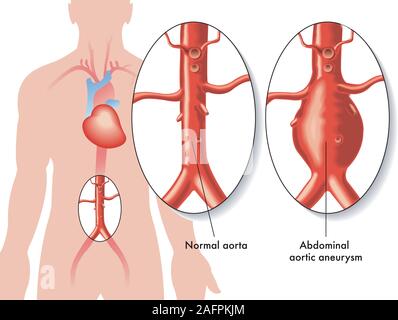 Medical illustration of the effects of Abdominal aortic aneurysm. Stock Vector