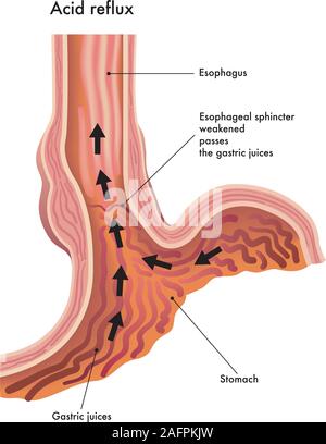 Medical illustration of the effects of the acid reflux. Stock Vector