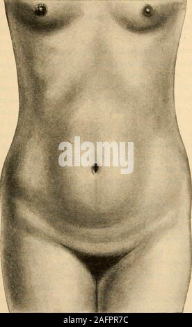 . Anatomie médico-chirurgicale de l'abdomen. Fi g. 1. — Face antérieure de labdomen chez lhomme jeune. I. F âge 9. R. Grécoire. Planche II (page 10).. Stock Photo