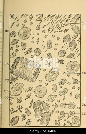 . Urinary analysis and diagnosis by microscopical and chemical examination. puscles are frequently found, but in smallnumbers only, and they may also be seen edgewise. When they have im-bibed water, they swell, and may be even double their usual size. Again,a varying number of haematoblasts, which present the features of red Iblood-corpuscles, but are only half their size, are often seen in an activehemorrhage. White blood-corpuscles, which may be twice the size of thefully formed red blood-globules, and cannot be distinguished from pus-corpuscles, are present in small numbers. They are always Stock Photo