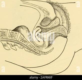 Clinical gyncology, medical and surgical. lia.—In polythelia the  supernumerary nipples follow a linefrom the normal nipple downward and  inward, or upward and outward.This, according to Wiedersheim, would  correspond to the milk-line