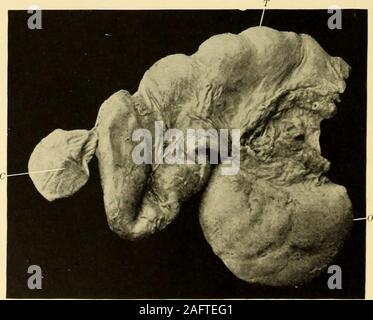 . Clinical gyncology, medical and surgical. Pyosalpinx.— T, tube; O, ovary with surface adhesions. Plate III.. Pyosalpinx.—T, tube with ampulla empty, in order to show constrictions :0, ovary ; C, small cyst. INFLAMMATION OF THE FEMALE GENITAL ORGANS. 343 udates within the tube, and the accumulation of such substances accountsfor the enlargement which the ampulla of the tube undergoes. The greaterenlargements occur as the result of closure of both ends of the tube, thelesser are found in conjunction with a free uterine end, the contents of thetube thus having opportunity for escape into the ut Stock Photo