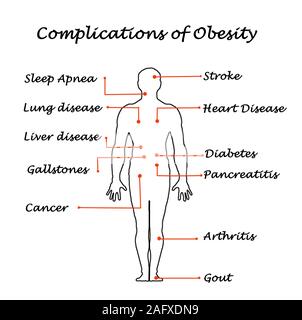 Complications of Obesity Stock Photo