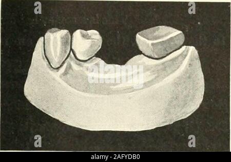 . The science and practice of dental surgery. Fic;. 857 -Case 5. Fig. S55.—Case 4. Stock Photo