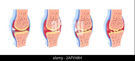 3d illustration of healthy and spherical synovial joint. In four representations standing and isolated on white background. Stock Photo