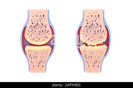 3d illustration of healthy synovial joint and with osteoarthritis. Images isolated on white background front view. Vivid colors. Stock Photo