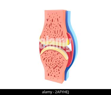 3d illustration of healthy synovial joint and with osteoarthritis ...