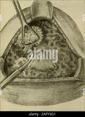 Laparotomy surgery. Open laparotomy incision in a patient's abdomen ...