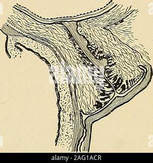 The diagnosis, pathology and treatment of diseases of women including the  diagnosis of pregnancy. In early pregnancy, difficult micturition,  persist-ing for some time and increasing, should lead us to suspect  retro-flexion