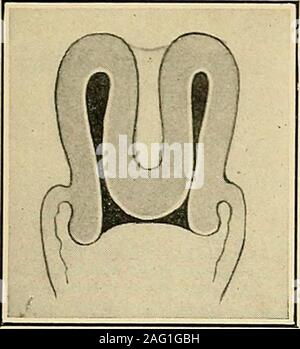 . The diagnosis and treatment of diseases of women. Fig. 315. Submucous Fib-roid and beginning Inversion. DIAGNOSIS OF INVERSION OF UTERUS 229. Stock Photo