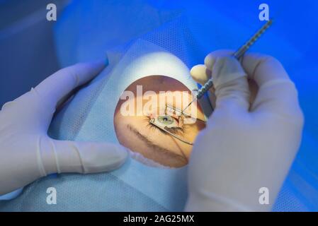 A close-up of the work of an ophthalmologist, behind the laser eye microsurgery apparatus. A doctor using a microsurgical instrument performs an opera Stock Photo