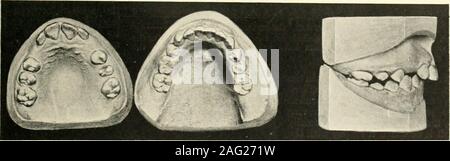 . The science and practice of dental surgery. Fio. 367.—Case 3. Before treatment. Fro. 308.—Case 3. After treatment.. Fig. 369.—Case 4. Before treatment. Stock Photo