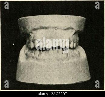 . The science and practice of dental surgery. Fig. 184. -Open bite associated with liypoplasia, anterior gingivitis, adenoids and small pharynx.Normal molar occUision. (Norman G. Bennett.) Stock Photo