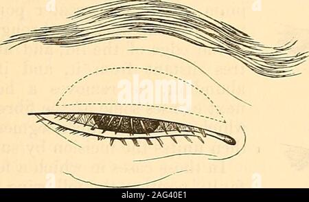 Incision lines on face in operating room Stock Photo - Alamy
