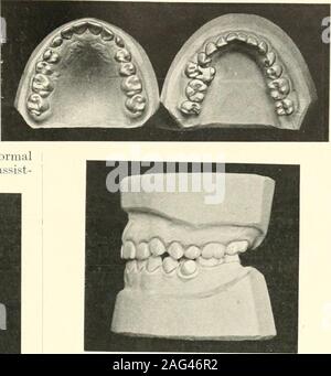 . The science and practice of dental surgery. Fig. 121).—Retained deciduous canines, left per-manent canine lingual to arch. (Norman G.Bennett.) Stock Photo