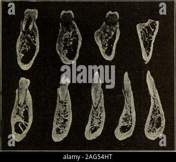 . Dental materia medica and therapeutics; with special reference to the rational application of remedial measures to dental diseases ... age, and is very readily ab-sorbed when the teeth are removed. The process is composedof soft, spongy cancelloid bone, which is penetrated by Haver-sian and Volkmanns canals (the latter carrying the vessels ofVon Ebner), and also contains lymph vessels. The anterior wallof the alveolar process of the maxilla is a thin plate throughout,except about the border of the molar teeth, while the posteriorsurface is reinforced by the intermaxillary bone and palatalpro Stock Photo