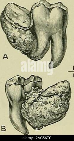 . Tumours, innocent and malignant; their clinical characters and appropriate treatment. Fig. 125.—Ossific ball in which the roots of two molars are embedded.The crown of one tooth is carious, a, The tumour entire; B, insection. [JIuseum of the Middlesex Sospital.) Radicular odontomes have been observed in the marmot,the porcupine, the agouti, and the boar (Figs. 127, 128),and in elephants. It is very probable that many, perhaps most, of thesethickened roots of tusks in boars and elephants and the. Stock Photo