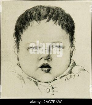 . The diseases of infancy and childhood : designed for the use of students and practitioners of medicine. * ym. W Fig. 100.—Congenital syphilis. Showing nnsal deformity. Newborn infant. the opposite condition obtains. On exposed areas, such as the knees,nates, soles of the feet, and palms of the hands, the skin is diffuselyindurated. In a detailed consideration of the lesions, those of the skin arethe first to engage attention. The most common forms of eruptionare the papular or the papulopustular form of syphilide. This maybe combined with the macular form; in fact, it is common to find inthe Stock Photo