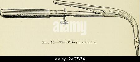 . The diseases of infancy and childhood : designed for the use of students and practitioners of medicine. Fig. 75.—ODwyer tube, obturator and handle.. Fig. 76.—The ODwyer extractor. Stock Photo