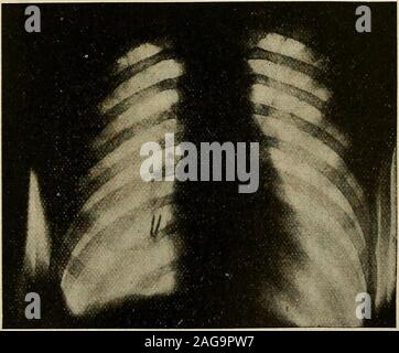 Modern Surgery General And Operative Fig 636 Radiograph Of A Boy Aged Eleven Years Showing Nail That Had Been In Lung Forabout Four Years Producing All The Symptoms Of Bronchiectasis Bronchoscopic Removal