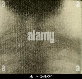 Cervical ribs and the transverse process of the cervical vertebra Stock ...