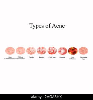 Types of Acne Skin inflammation. Pimples, boils, whitehead, closed comedones, papules, pustules, cystic acne. Infographics. Vector illustration on Stock Vector