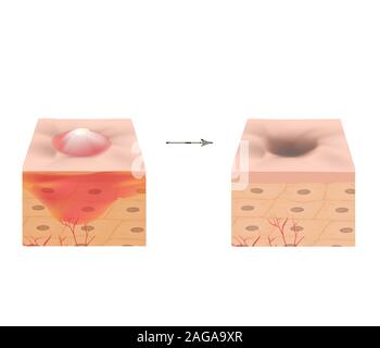 Inflamed acne on the skin. Inflamed pimple. The structure of the skin. Acne scar. Infographics. Vector illustration on isolated background. Stock Vector