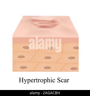 Types of scars. Acne scars. Keloid, hypertrophic, atrophic ...