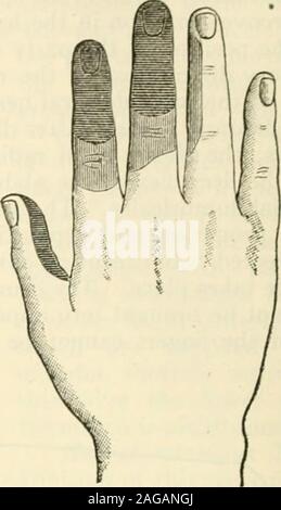 . Modern surgery, general and operative. Fig. 548.—Section of median nerve; areasof anesthesia (heavy shading) and of dyses-thesia (light shading) on palmar surface ofhand (Bowlby). Fig. 549.—Section of median nerve; re-gions of anesthesia and dysesthesia ondorsal surface of hand (Bowlby). supplied by the median nerve. Interosseal flexion is impossible, and the op-ponents of the internssei, acting without normal antagonism, contract and pro- Stock Photo