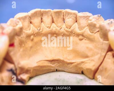 Metal-ceramic dental crown is tried on an gypsum model. Dental care concept. Human teeth with dentures on 3d model Stock Photo