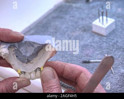 Metal-ceramic dental crown is tried on an gypsum model. Dental care concept. Human teeth with dentures on 3d model Stock Photo