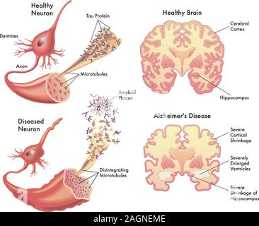 Medical illustration of the symptoms of Alzheimers disease. Stock Vector